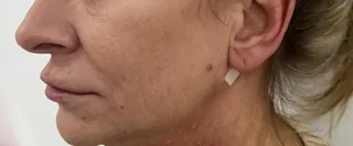 Miniatura: profil po HIFU