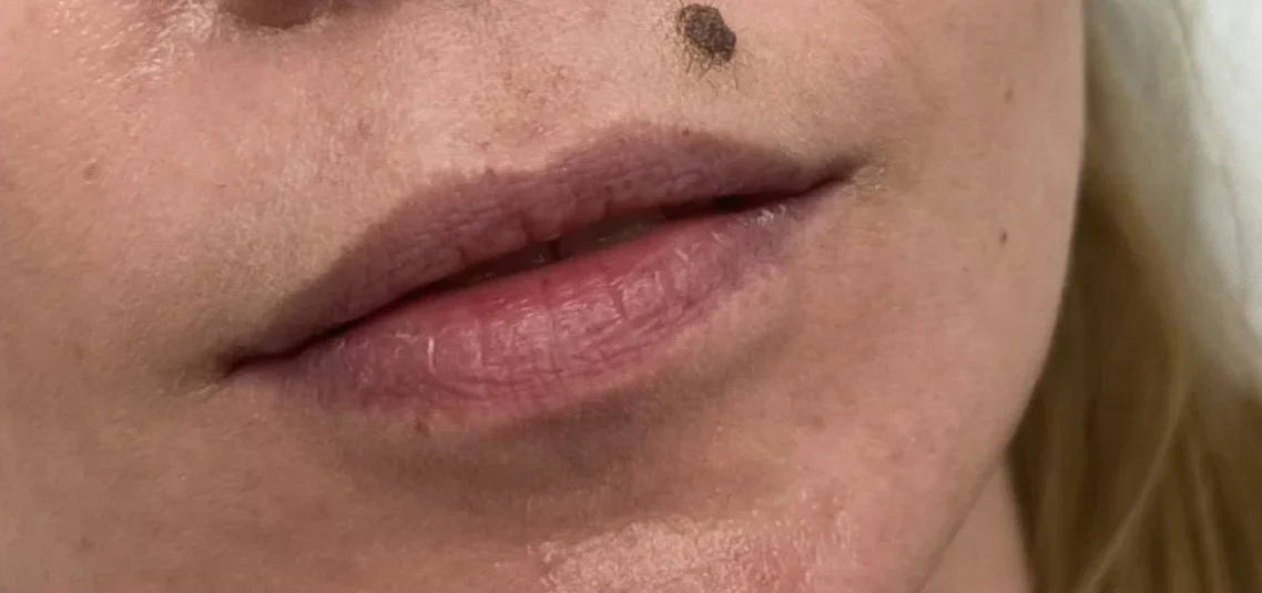 Usta – przed zabiegiem