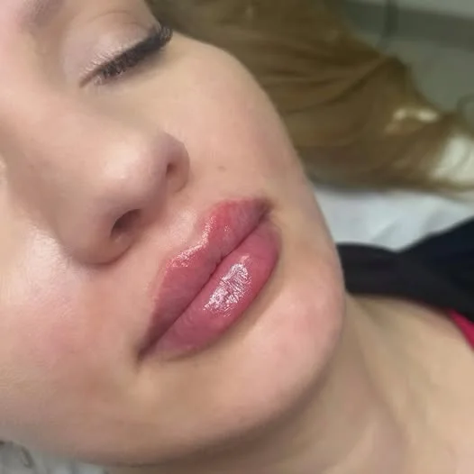 Zbliżenie na usta bezpośrednio po zabiegu modelowania kwasem hialuronowym. Widoczna naturalna opuchlizna.