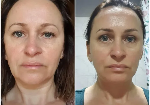 Twarz pacjentki przed i po zabiegu HIFU. Widoczna poprawa napięcia skóry i owalu twarzy.